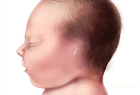 A missing external ear is a congenital birth defect that can be corrected with plastic surgery.