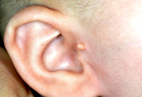 A skin tag on the ear may be a sign of kidney trouble. 