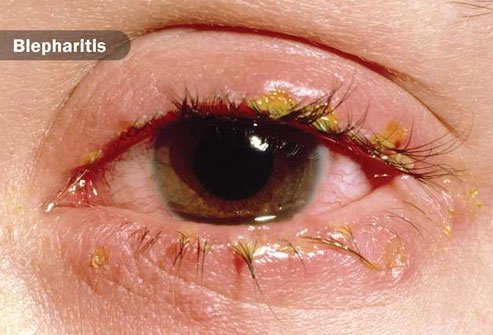 When tears and oils dry, they can leave a sticky crust on your lids or lashes.
