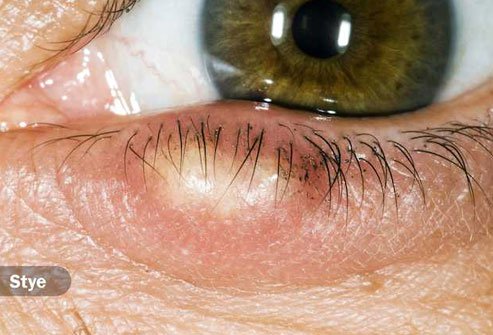 Styes are red, painful lumps on your lashes or under your lid.