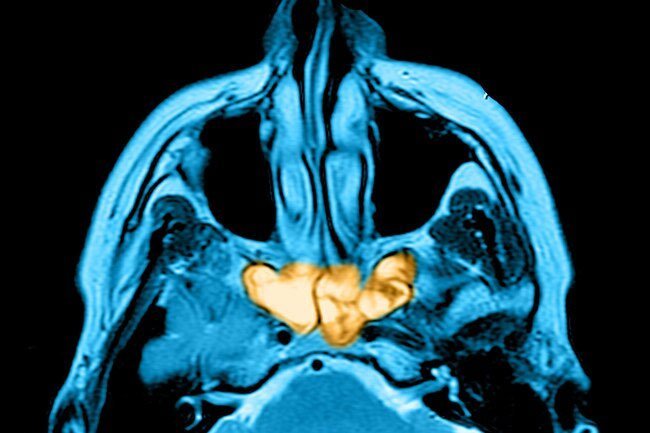 Sinus infections can alter or interfere with your sense of smell.