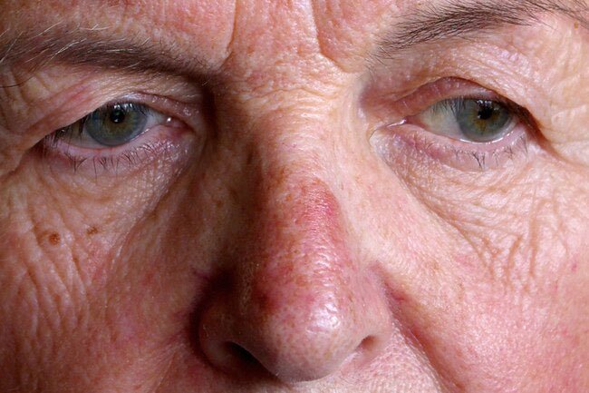 Thick red skin on the nose may be a sign of rosacea.