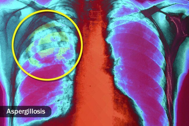 Black nasal mucus may be a sign of a fungal infection.