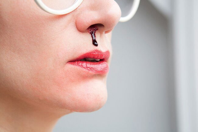 Nosebleeds may be caused by a variety of conditions and medications.