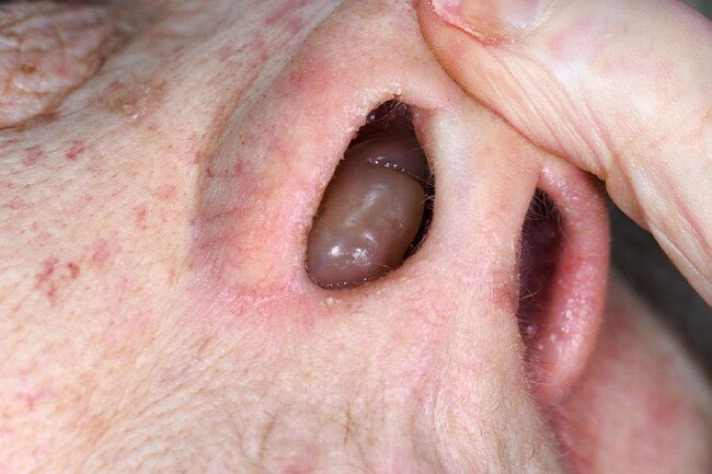 Polyps may interfere with your sense of smell.
