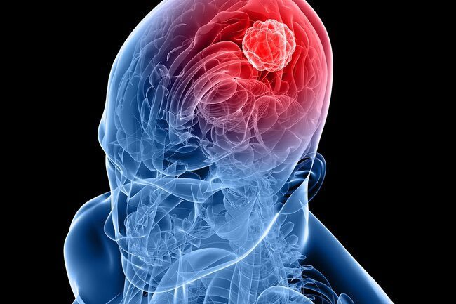 Phantom smells may be due to epilepsy, brain tumors, Parkinson's disease, and other disorders.