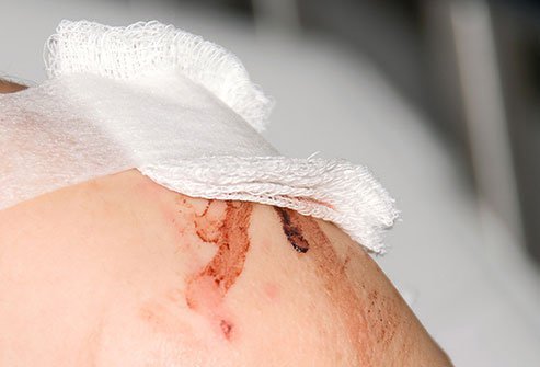If you can see yellow fatty tissue under the first layer of skin, you should get to the emergency room.
