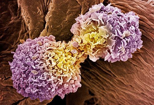 If your doctor told you that your breast cancer has spread to other parts of your body, it is at a more advanced stage than if it's only in your breasts.