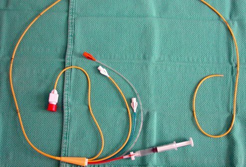 Pulmonary artery pressure monitoring involves inserting a pressure sensor via catheter in the artery that carries blood between the heart and lungs. This can help diagnose heart failure, clots and other cardiovascular problems.