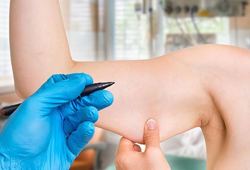 A Nexplanon implant is a long-term and effective birth-control method for women.