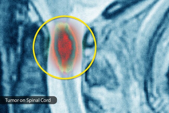 This can happen with cancerous or noncancerous tumors.