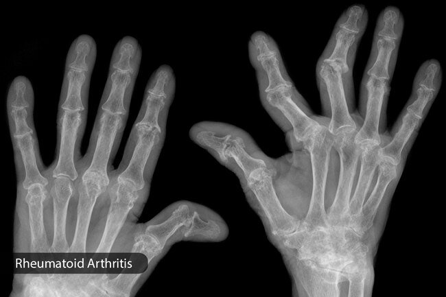 Autoimmune diseases (like lupus and rheumatoid arthritis) make your immune system start fighting parts of your own body, like your nerves.
