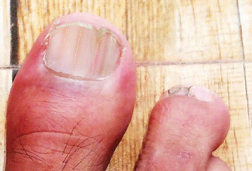 When toenails have red and white stripes, there are usually problems elsewhere on your body.