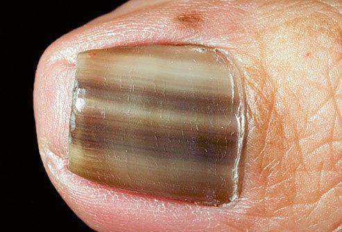 The term for brown and sometimes black color on your toenail is melanonychia.