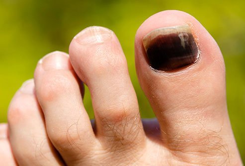 If your toenail turns black, it's most likely a bruise under the nail, technically called a subungual hematoma.