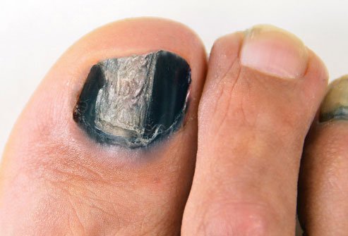 Say you're not a runner, your shoes are roomy, and you're sure you haven't hurt your toe -- yet you have one or more black toenails.