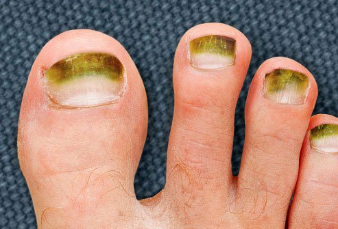 Unless you're wearing green nail polish, this is a color you don't want to see on your toenails.