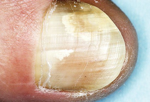 Do you have a toenail that's turned white, or has large powder-like patches?