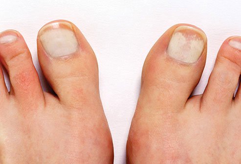 Another type of fungal infection is called proximal subungual onychomycosis.