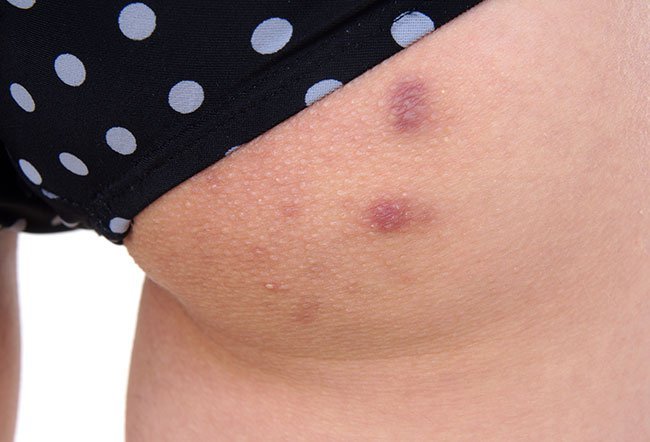Pimples on the butt occur due to staph bacteria on the skin. They also occur as a result of wearing tight clothing and using abrasive cleaners on the area.