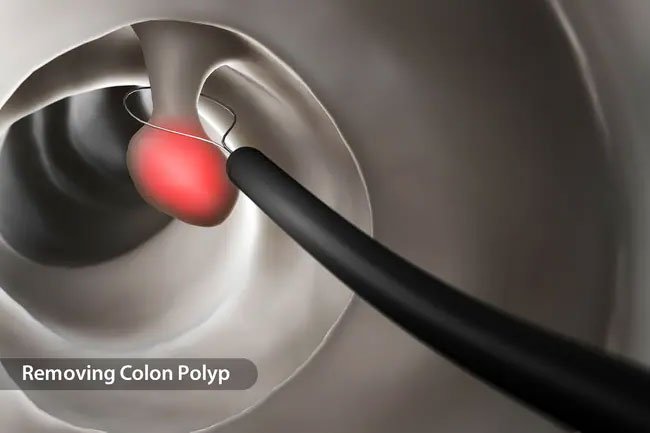 Colon polyps may cause blood in the stool, although it is rare.