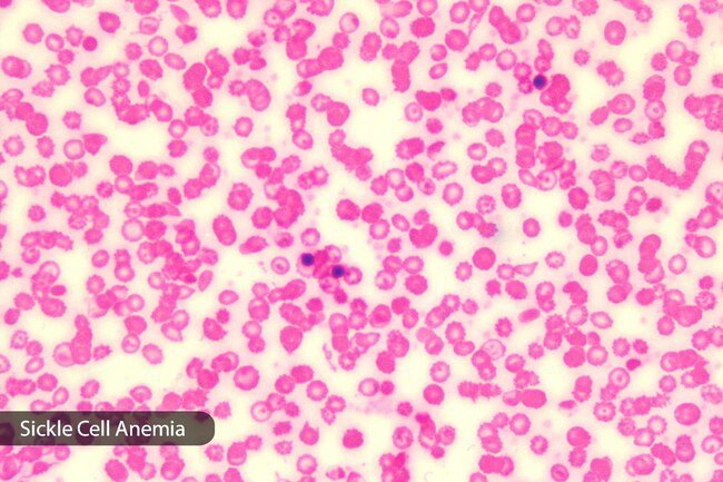 It's common to feel tired, weak, and cold when you have anemia.