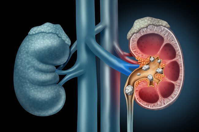 When kidney stones get stuck and cause an infection, you may get chills, nausea, and fever.