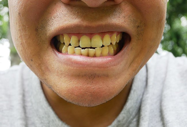 why do I have yellow teeth