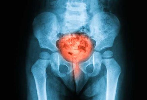 Interstitial cystitis causes painful and uncomfortable bladder symptoms as well as the urge to pee.