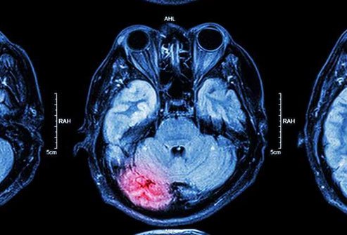 A stroke or other brain condition may lead to increased urination.