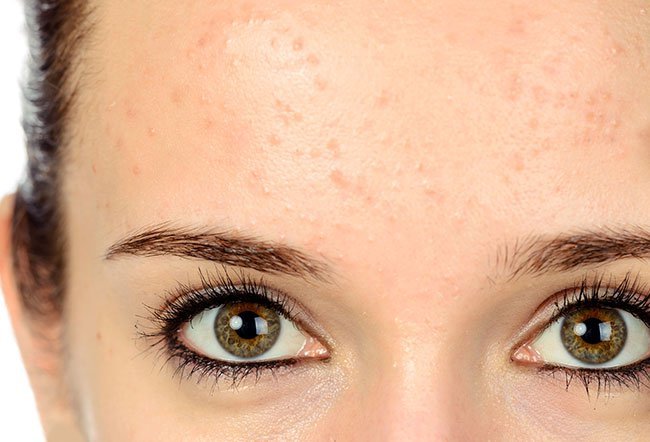 Forehead pimples are usually caused because blocked pores on your skin. Your forehead tends to be an area where the skin gets naturally oily from it's own skin oils, oil from your hair, or skincare products that block your pores.