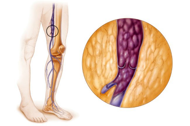 Deep vein thrombosis may cause pain in your calf.