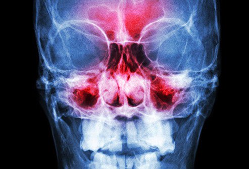 A simple cold can inflame hollow areas behind your cheekbones and forehead