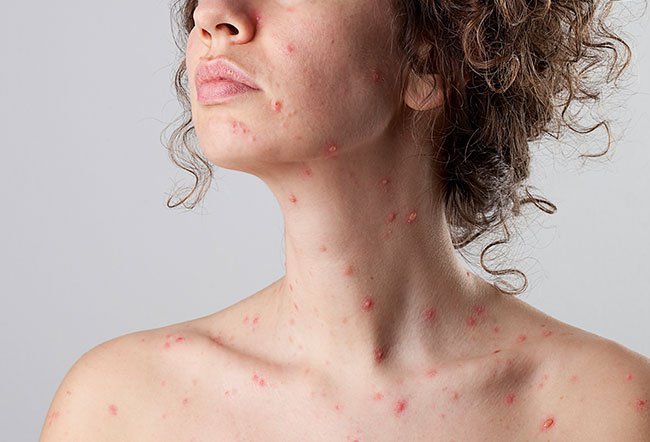 Chickenpox is a highly infectious disease that can have severe complications in adults. Adults are 25 times more likely to die from chickenpox than children are.