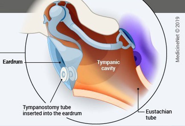 A myringotomy is a surgical procedure in which a small incision (cut) is made on the eardrum to remove any accumulated fluid, blood, or pus from the middle ear.