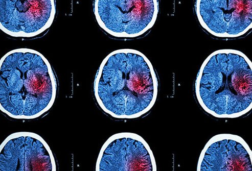 Sufficient potassium levels may help decrease the risk of stroke.