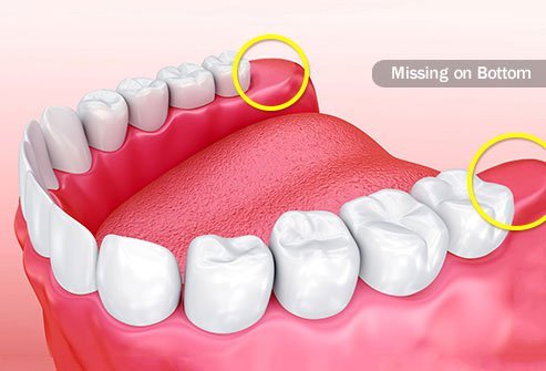 Wisdom teeth once helped our ancestors chew through tough foods like roots and leaves.