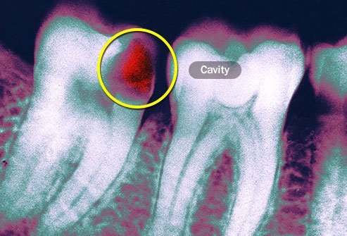When they grow in, wisdom teeth may cause health problems, including bone loss.