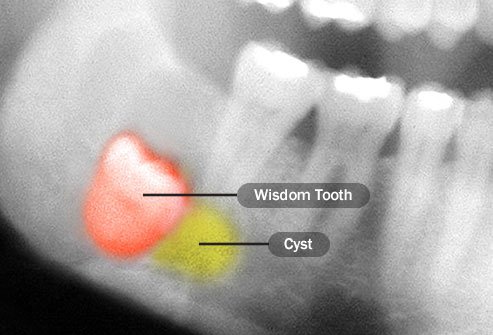 Preventive wisdom tooth removal has become controversial over the last decade.