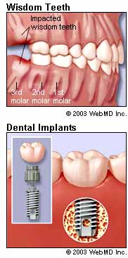 Wisdom Teeth and Dental Implants