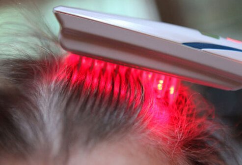 There’s help for hair loss in women from low-level laser therapy.