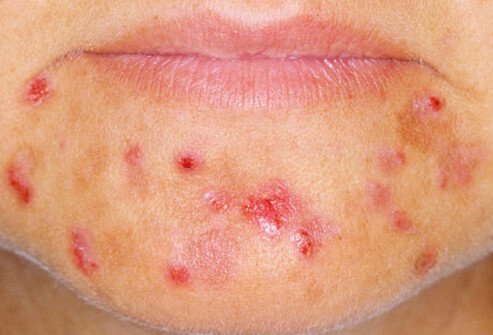 PCOS causes acne, hair loss, and other symptoms.