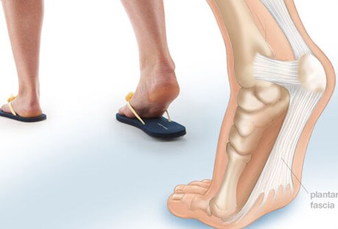 Photo of plantar fasciitis.