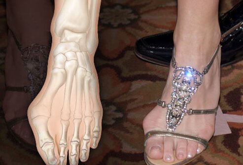 Photo of painful bunion.