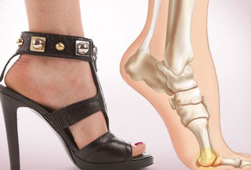Photo of foot pain from heels.