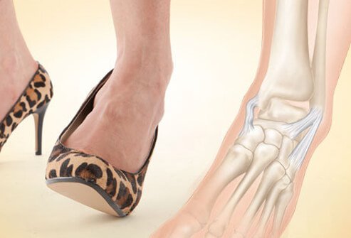 Photo of ankle sprain risk.