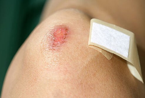Cuts and scrapes first aid – should it include airing out the wound or covering it up?