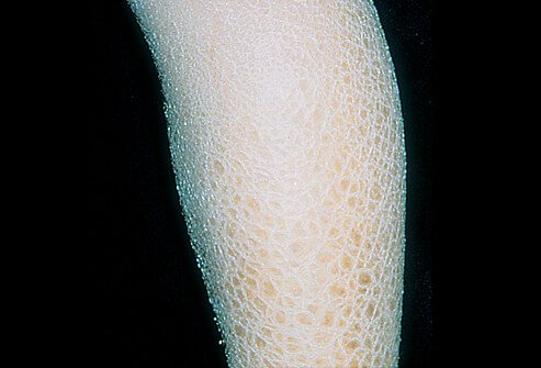 Picture of X-Linked Ichthyosis