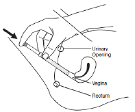 Insert the filled applicator - Illustration