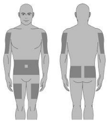 Select the number and location of infusion
sites  - Illustration